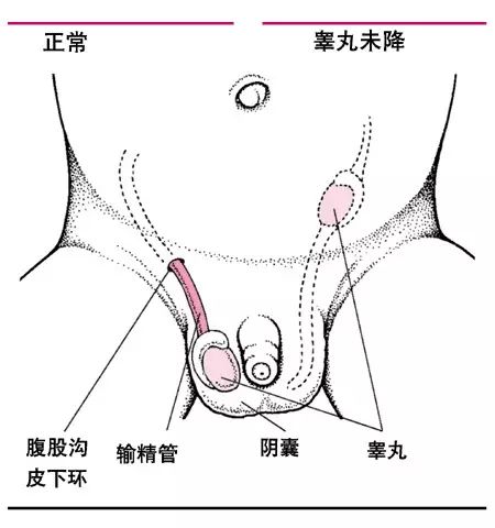 关于隐睾丸真假之分的研究与探讨