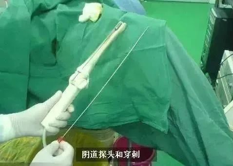 取卵针的长度，深度解析与探讨