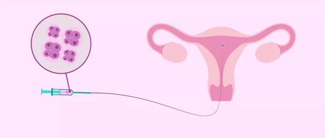 关于取卵后的女性健康与心理调适