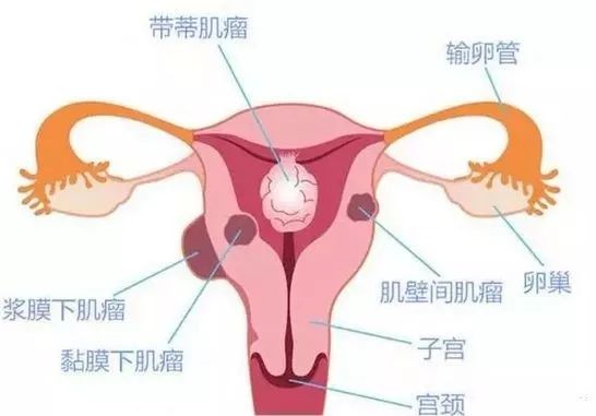取卵后疼痛正常吗？解读女性生殖健康中的常见问题