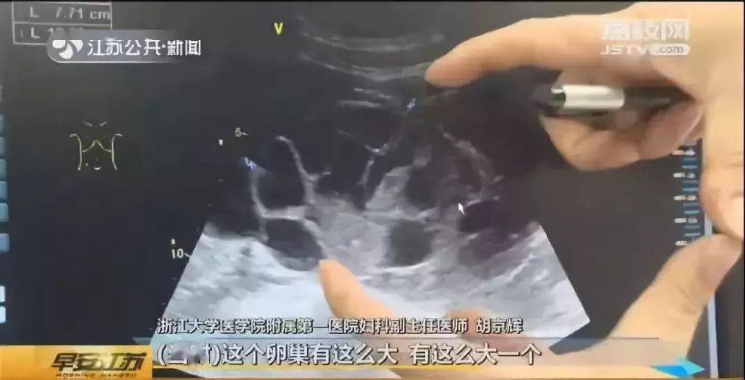 探究取卵过程中腹水的成因